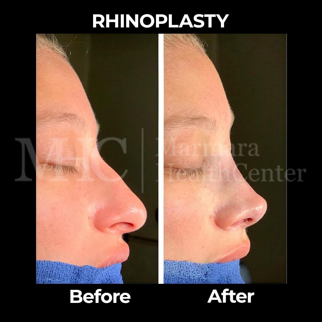 Rhinoplasty before-after result #23 — Marmara Health Center