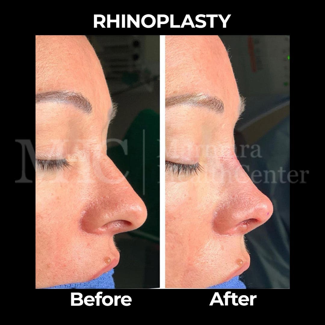 Rhinoplasty before-after result #24 — Marmara Health Center
