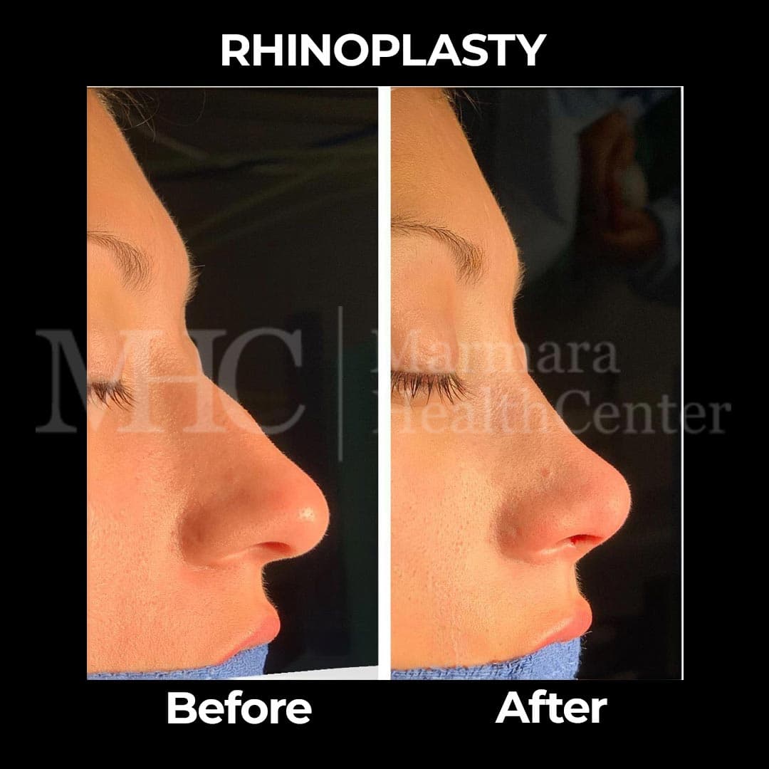 Rhinoplasty before-after result #25 — Marmara Health Center