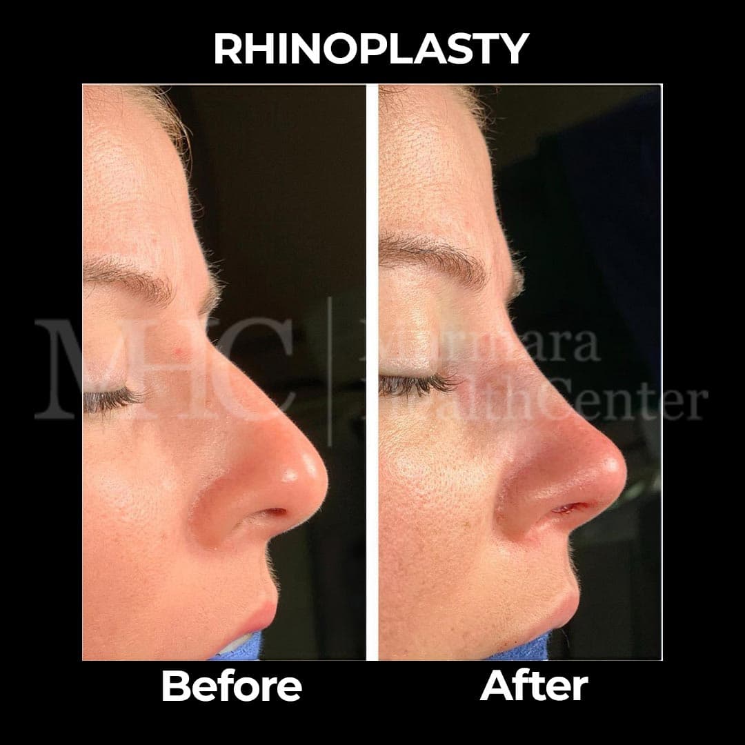Rhinoplasty before-after result #26 — Marmara Health Center