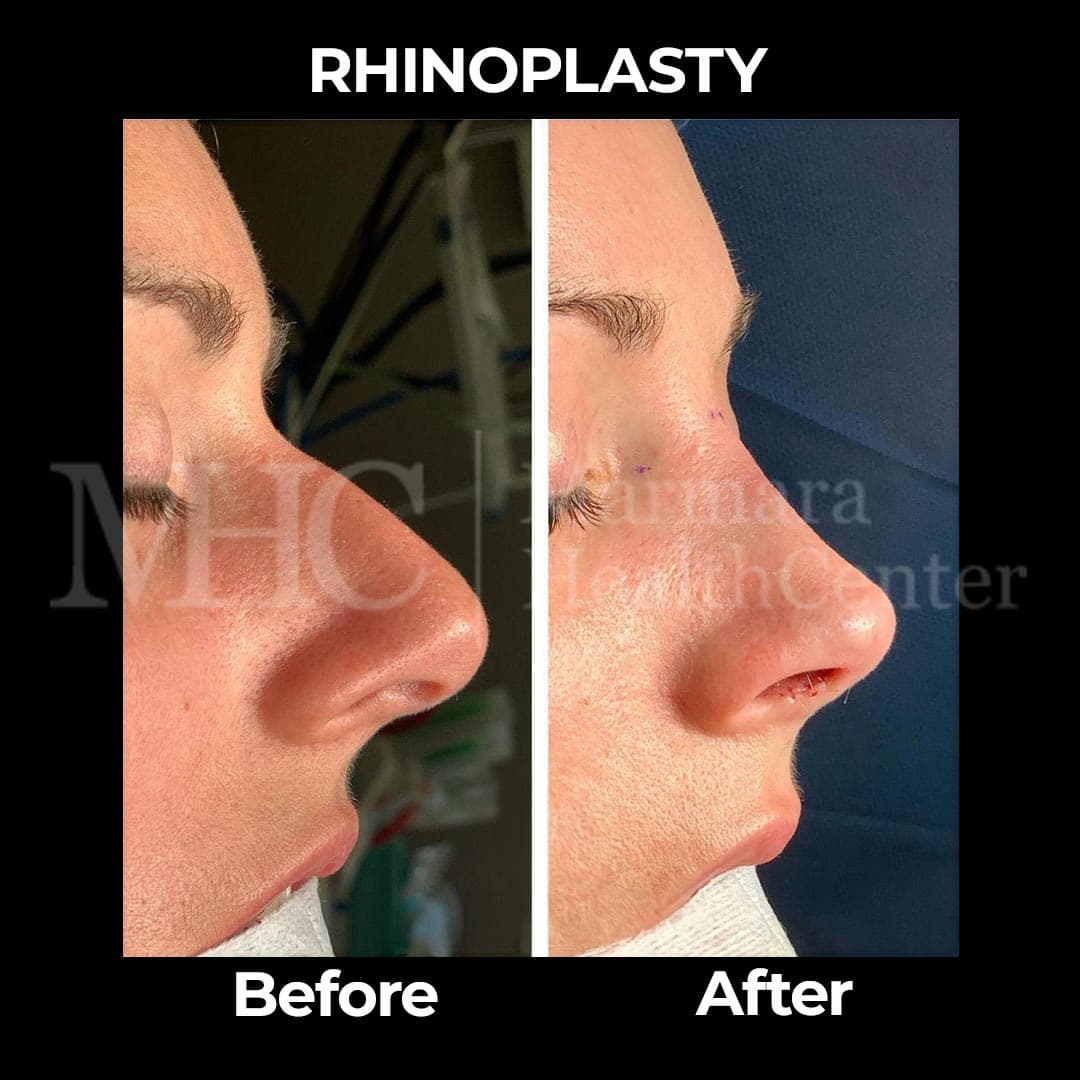 Rhinoplasty before-after result #27 — Marmara Health Center