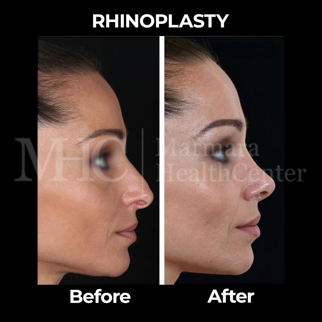 Rhinoplasty before-after result #28 — Marmara Health Center