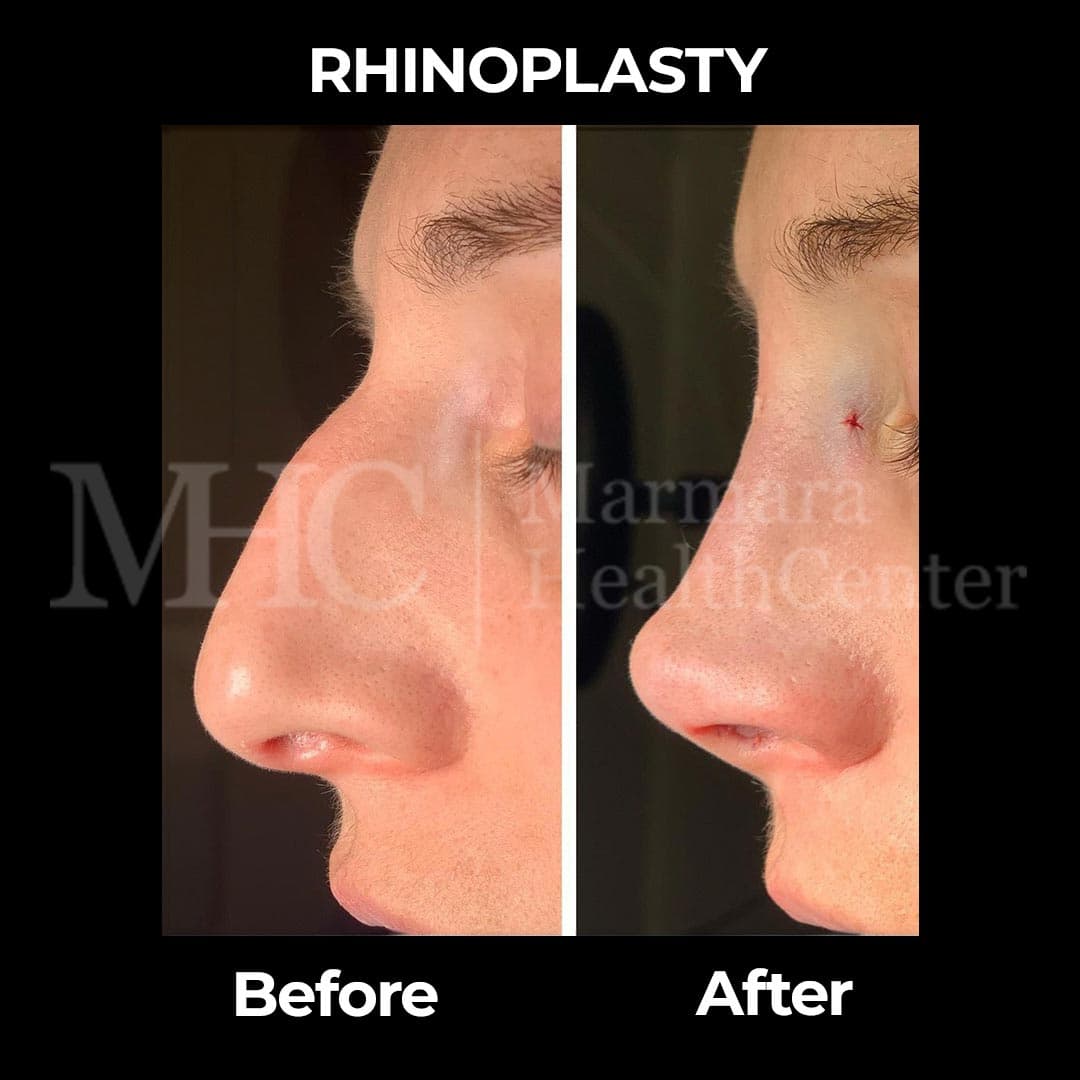 Rhinoplasty before-after result #29 — Marmara Health Center