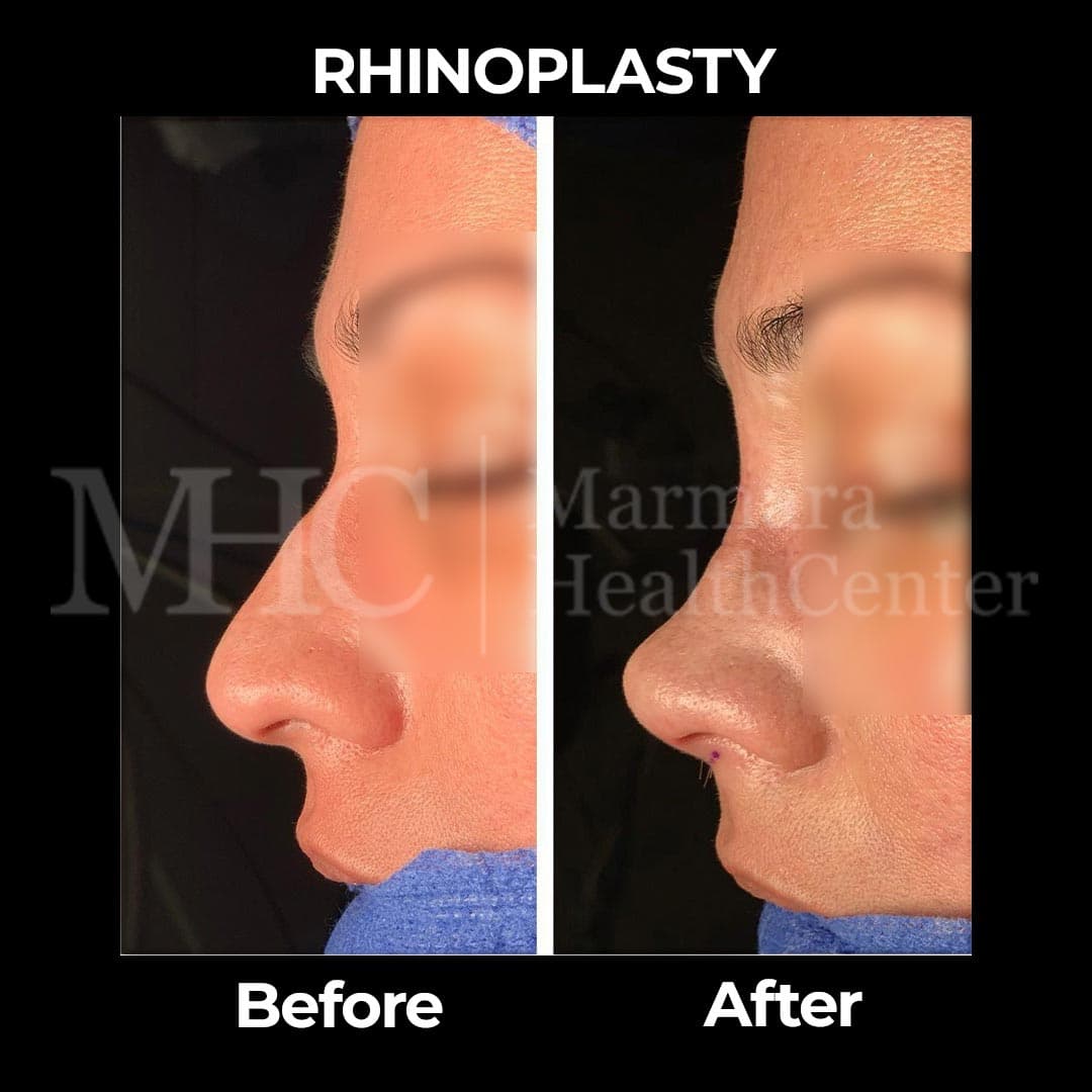 Rhinoplasty before-after result #30 — Marmara Health Center