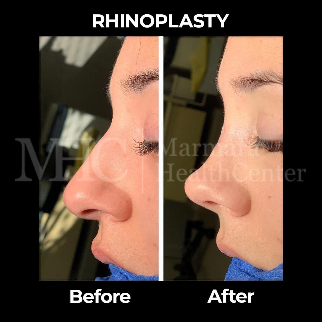 Rhinoplasty before-after result #31 — Marmara Health Center