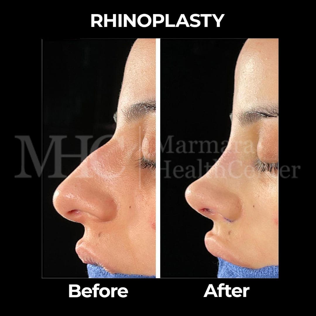 Rhinoplasty before-after result #32 — Marmara Health Center