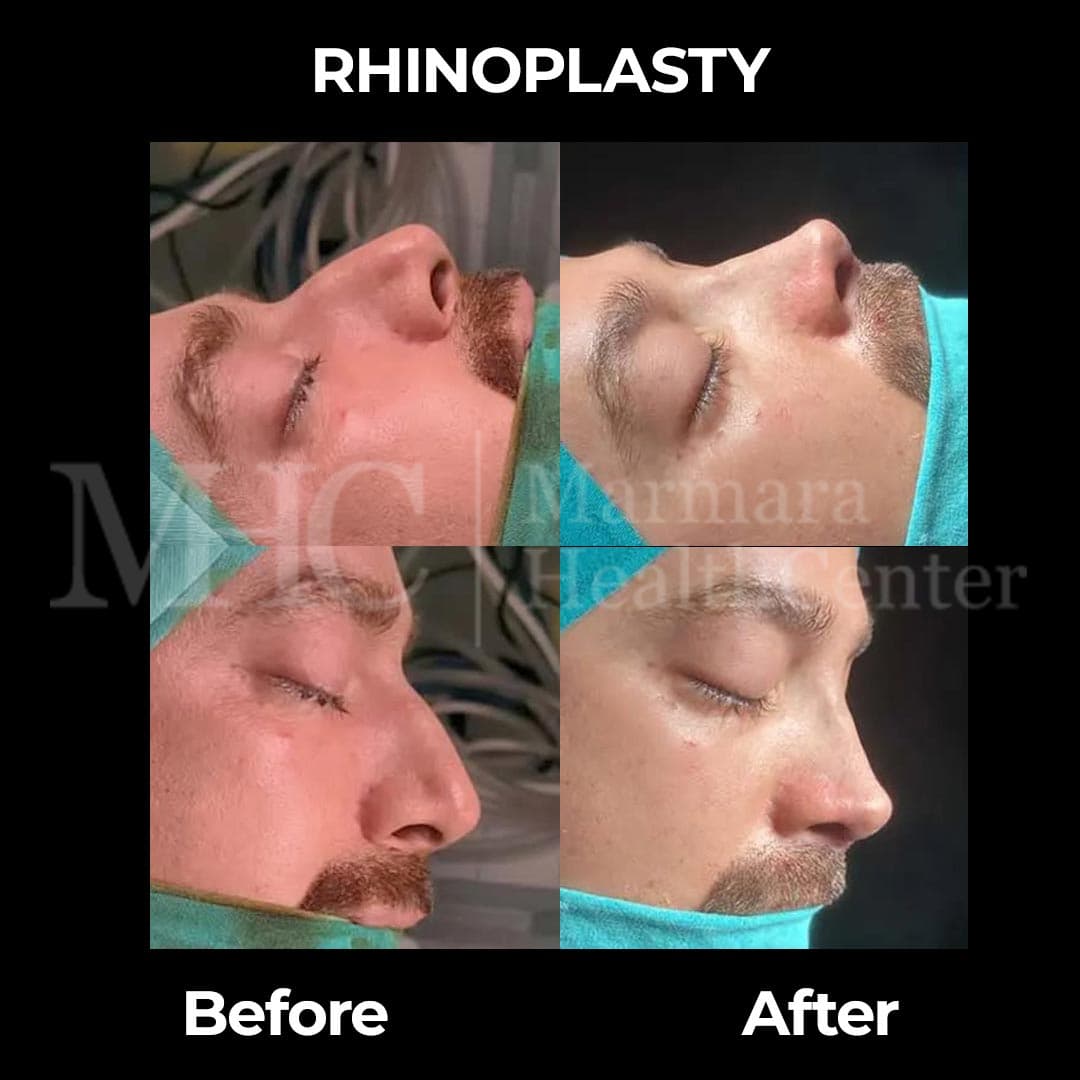 Rhinoplasty before-after result #4 — Marmara Health Center