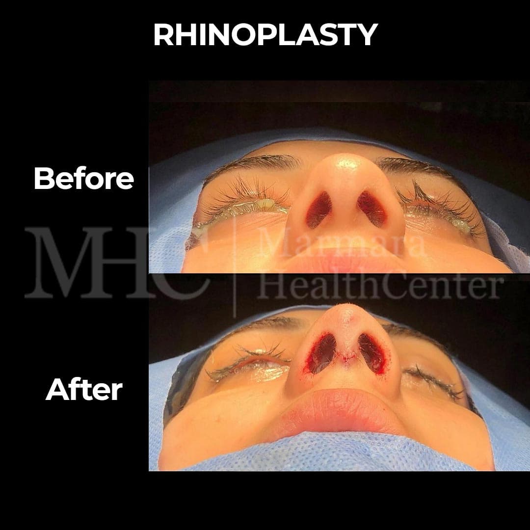Rhinoplasty before-after result #5 — Marmara Health Center