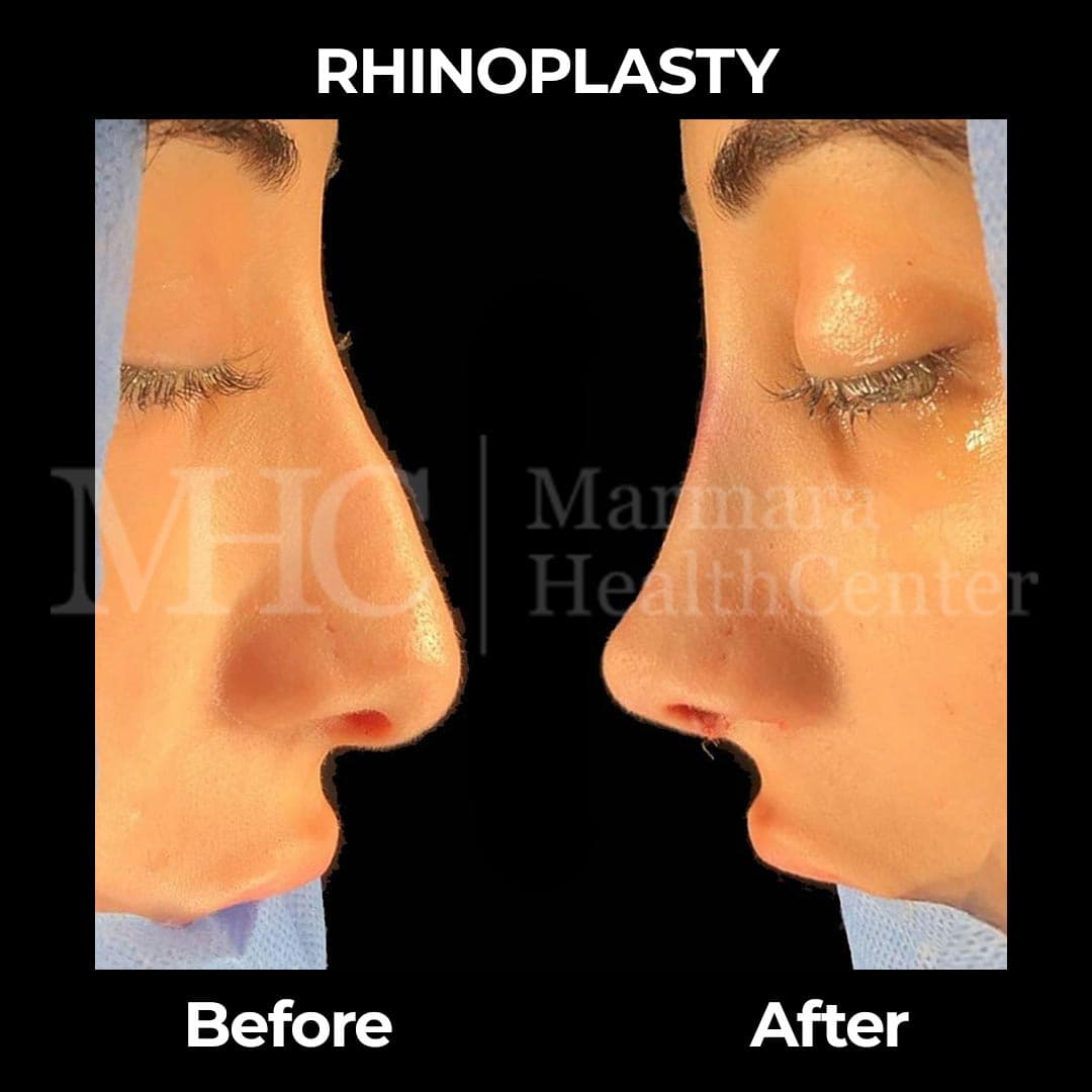 Rhinoplasty before-after result #6 — Marmara Health Center
