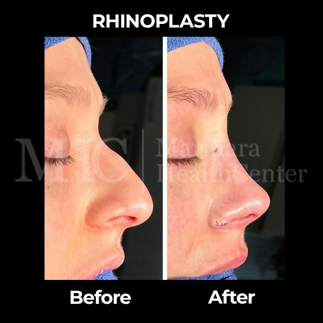 Rhinoplasty before-after result #7 — Marmara Health Center
