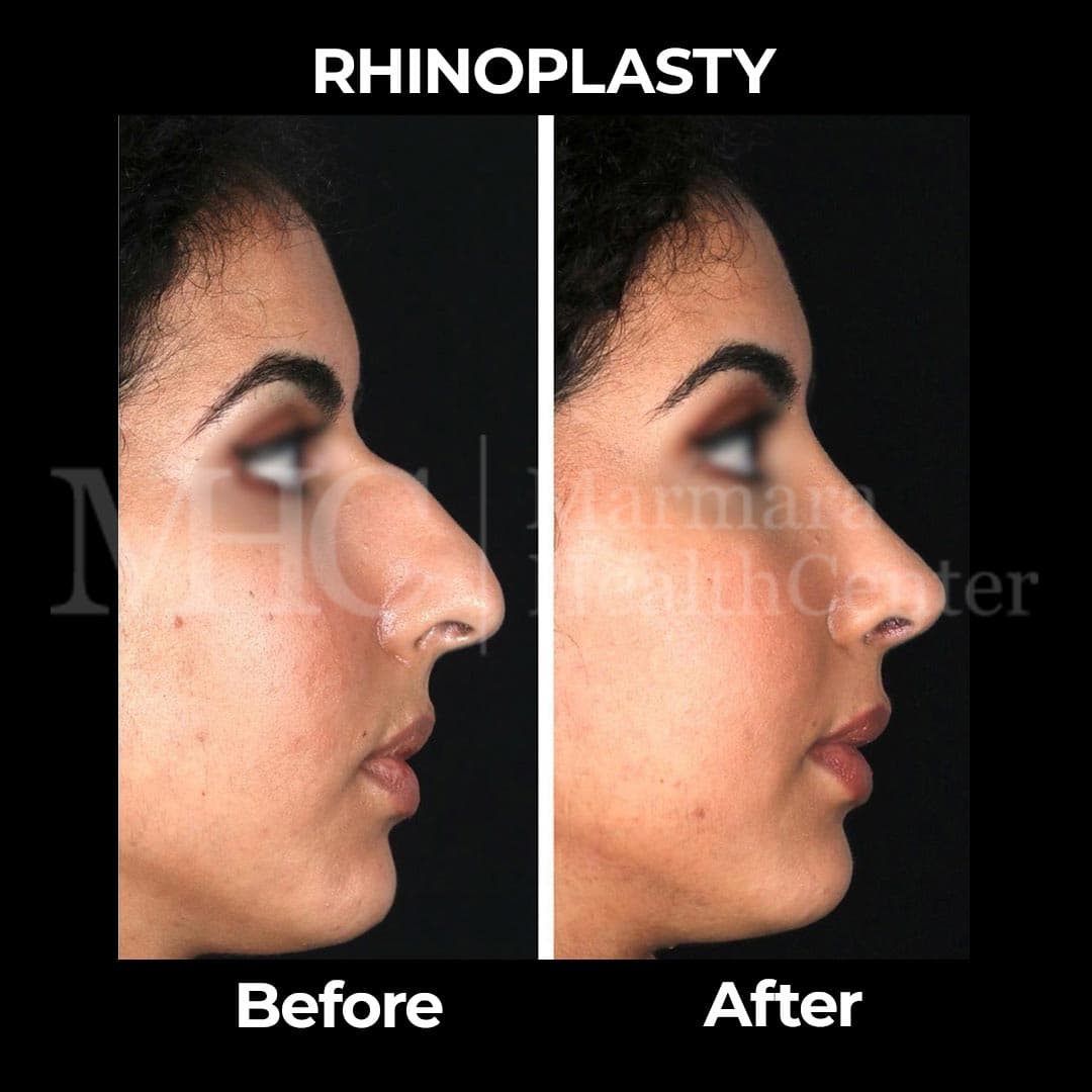 Rhinoplasty before-after result #8 — Marmara Health Center