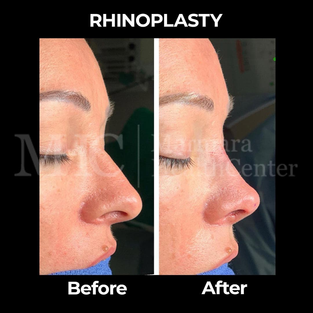 Rhinoplasty before-after result #9 — Marmara Health Center