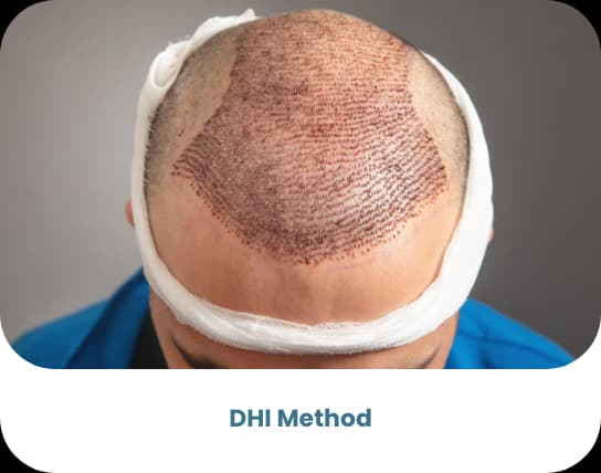 DHI Haartransplantation — bariatrische Behandlung