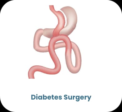 Diabeteschirurgie — bariatrische Behandlung