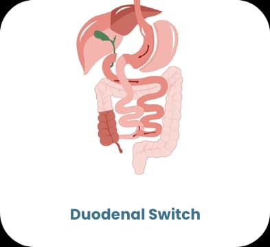 Duodenal-Switch — bariatrische Behandlung