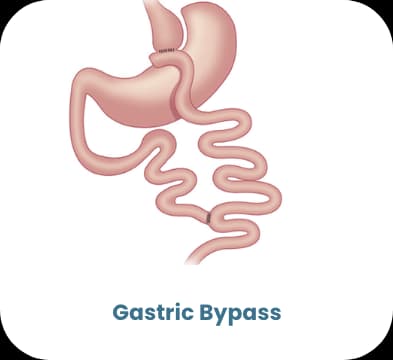 Magenbypass — bariatrische Behandlung